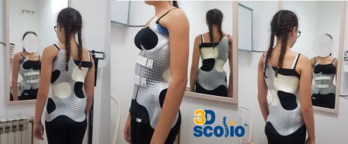 3dscolio-example-3